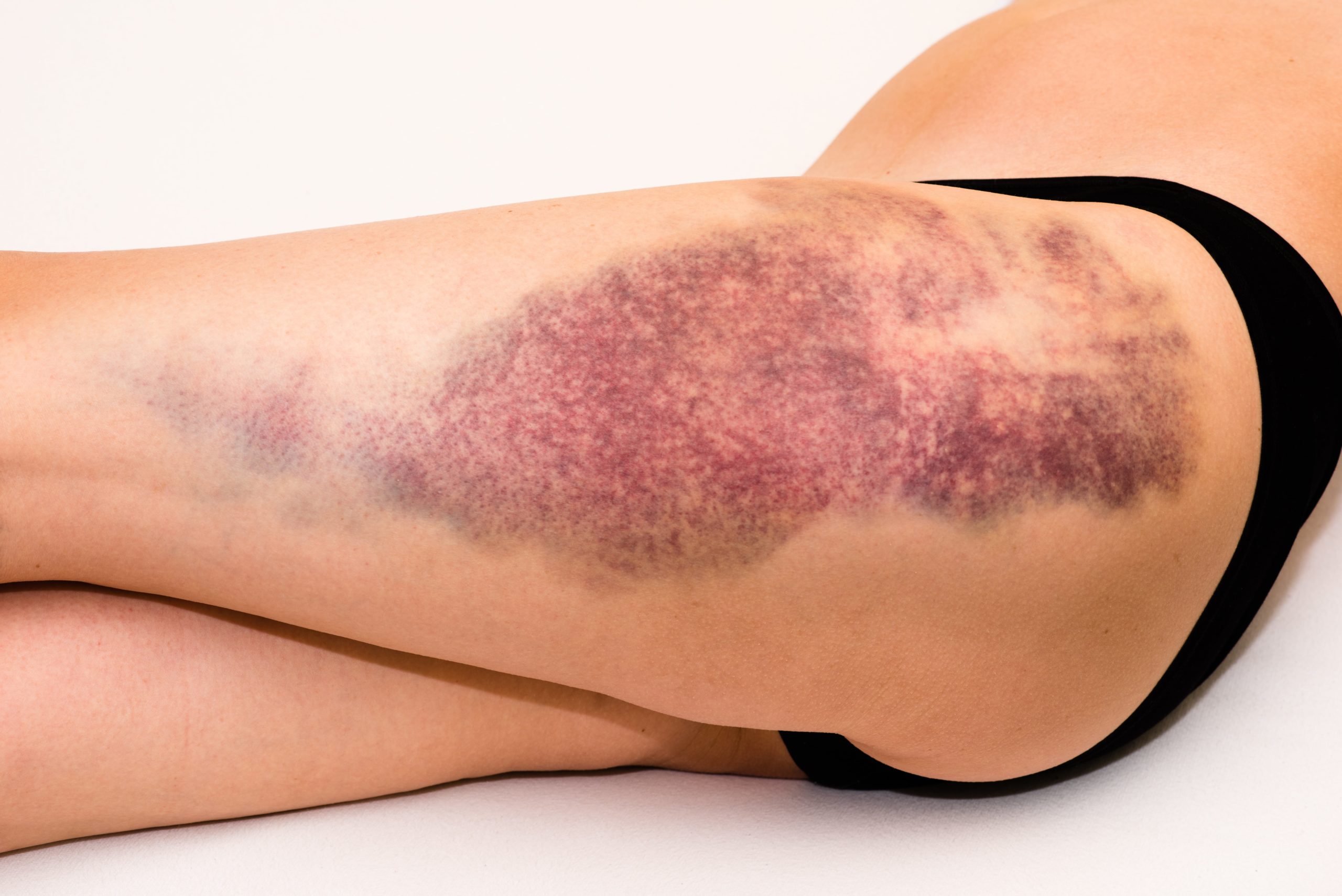 ¿Cuáles son los signos de una hemorragia interna o de lesiones en los tejidos blandos tras un accidente de tráfico?